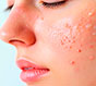 Що таке Акне? - Медицина у Дніпрі